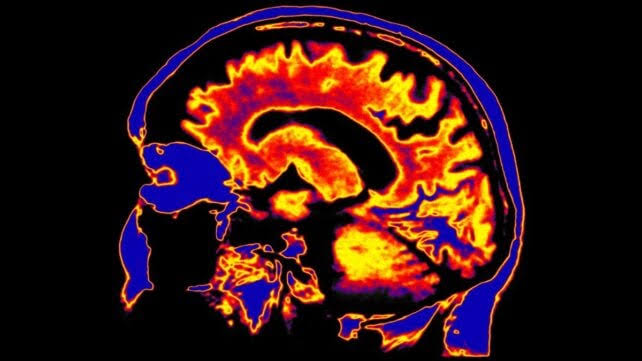 In a First, Chronic Fatigue Syndrome Linked to The Brain's Clearing System