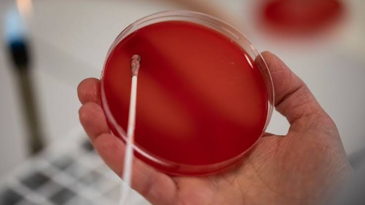 5 flesh-eating bacteria cases confirmed in US, more expected in summer