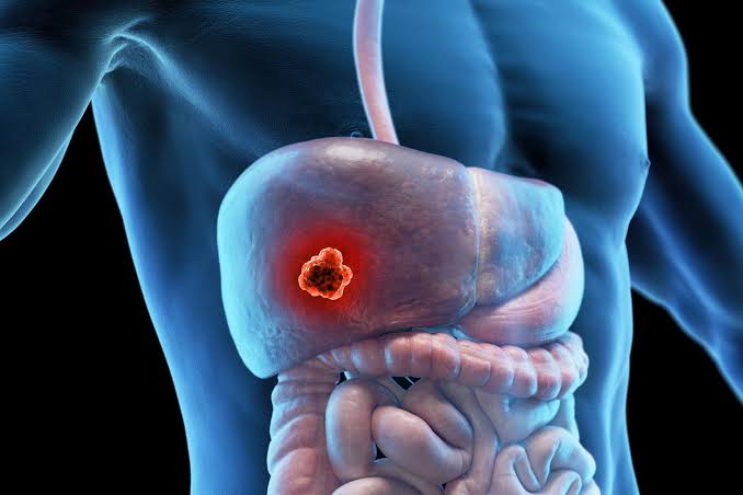 Scientists Uncover Cancer-Fighting Power of Popular Fatty Liver Drug
