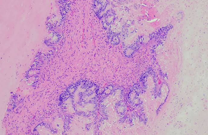 Experimental Drug Doubles Median Survival in Patients With Metastatic Pancreatic Cancer