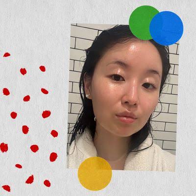 I Got an Accutane Nose Job