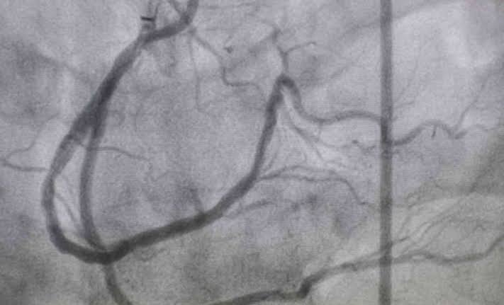 New stroke trial reveals why reopening a blocked artery is sometimes not enough