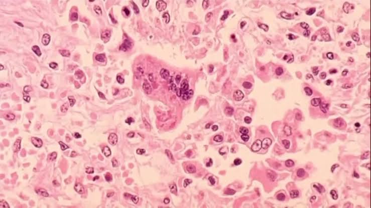 DPH confirms state's second measles case, first in a vaccinated adult