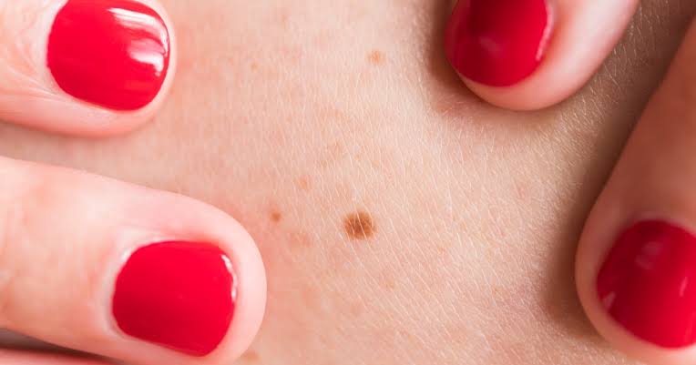 The ‘Big Sign’ of Melanoma and Skin Cancer Symptoms a Dermatologist Monitors in Herself