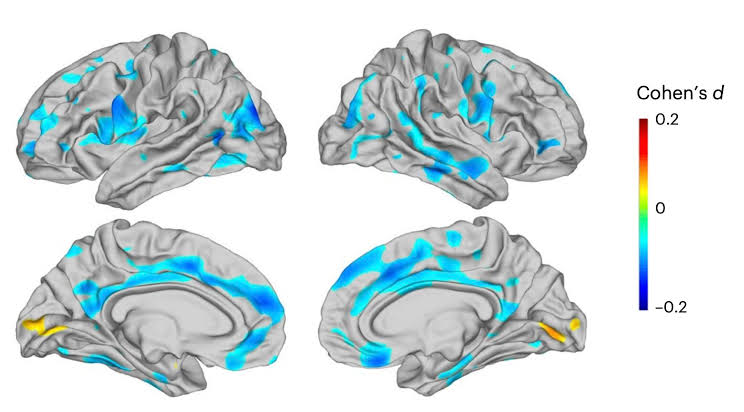 Large MRI analysis uncovers brain-region thinning tied to depression