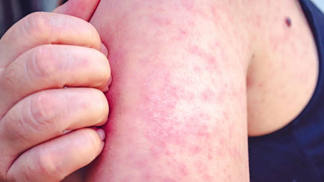 As child measles case reported in Delaware, what families should know