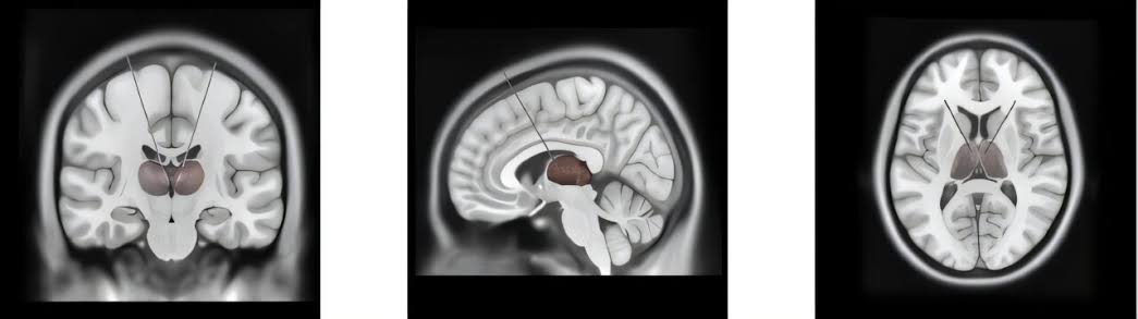 What separates dreaming from deep sleep? Brain rhythm offers new clue to consciousness