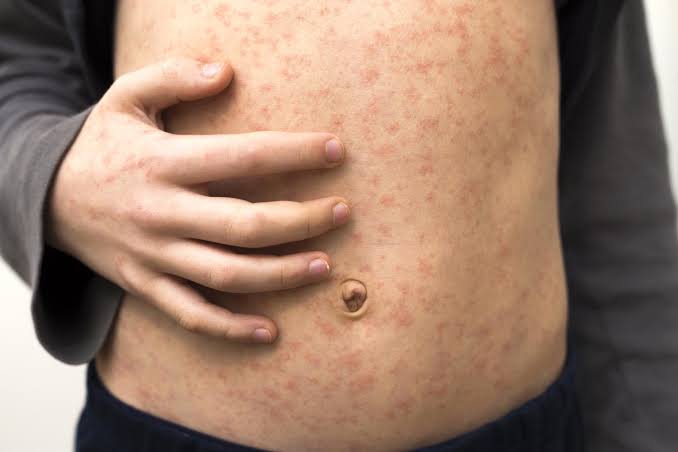 Two new reports highlight obstacles to containing US measles outbreaks