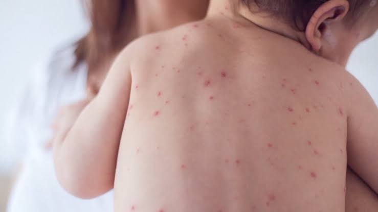 Delaware officials confirm 1st case of measles in more than a decade