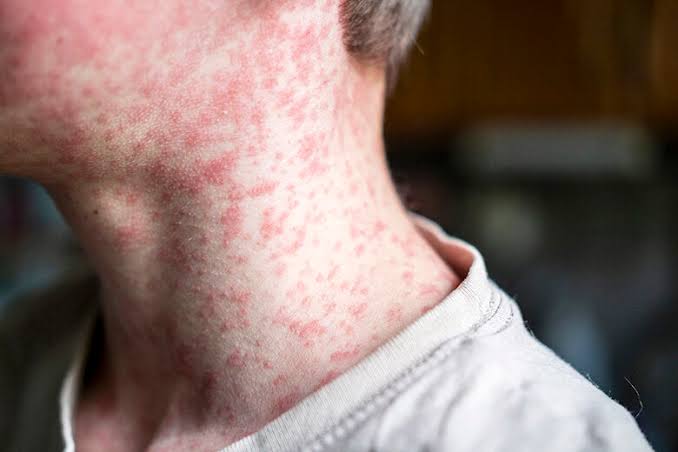 Maryland confirms 3 new measles cases, warns of possible exposures