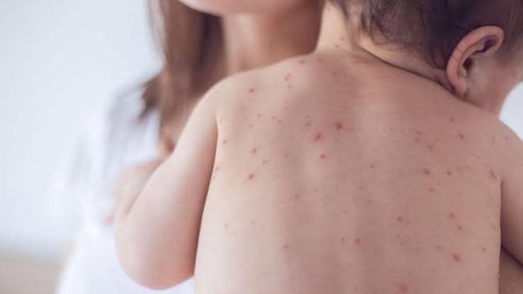 819 more suspected measles cases, one death recorded in 24hrs