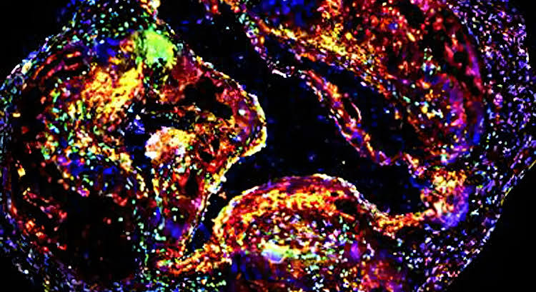Sleep and exercise may curb heart risk from mutant white blood cells
