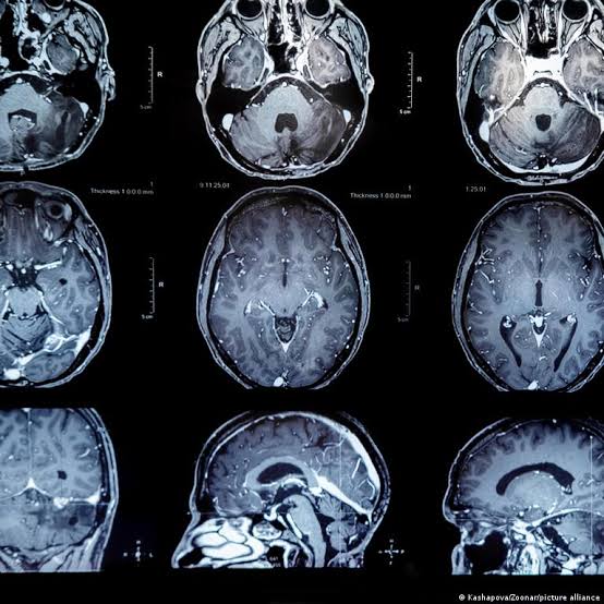 Brain tumors: New vaccine offers patients hope for more time
