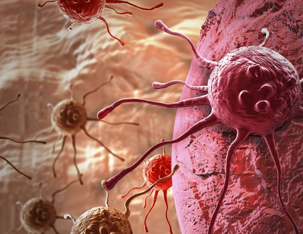Study identifies risk factors for early-onset colorectal cancer