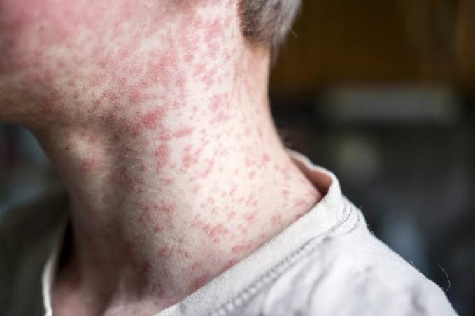 Suspected measles exposure at University Hospitals Rainbow Babies & Children’s Hospital