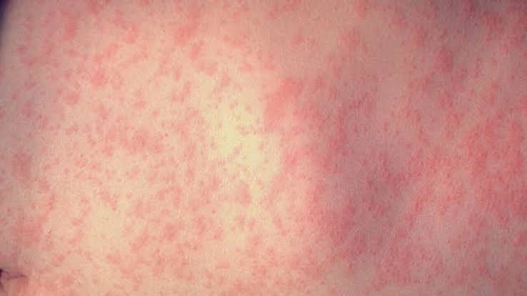 Measles confirmed at Safeway in Portland, health officials say