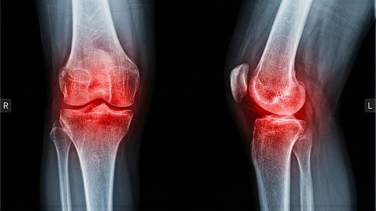 This Tiny-Bead Procedure Is Helping Patients Avoid Knee Replacement