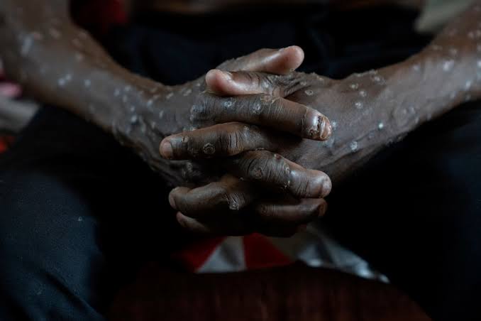 Congo says its mpox outbreak is over after 2 years and more than 2,200 suspected deaths