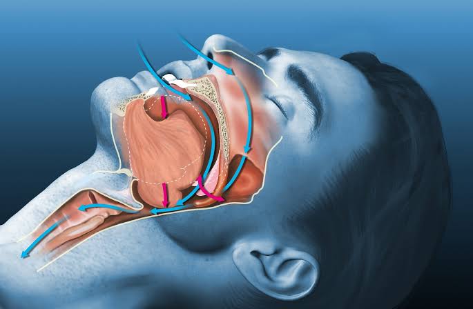 Oral AD109 improves sleep apnea severity but tolerability remains a challenge