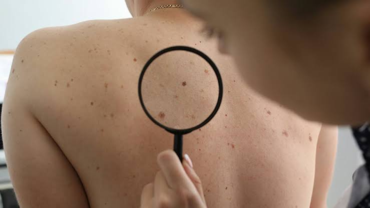 Dermatologist Reveals The Major Red Flag On Your Skin That Could Signal Heart Problems