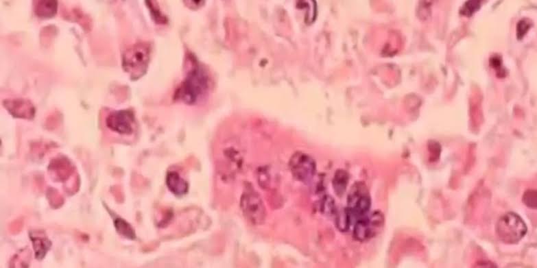 Measles outbreak declared in Ohio with cases reported in multiple counties