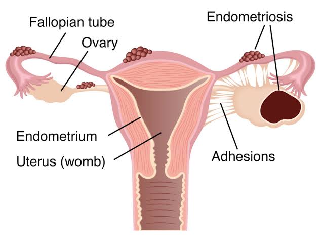 Endometriosis Patients Face Years-Long Diagnosis Delays as Healthcare System Tries to Bridge the Wait for Care