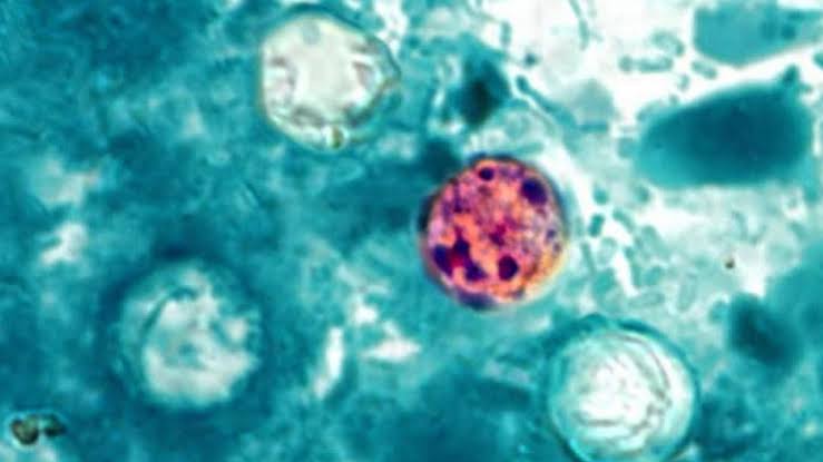 Cyclosporiasis symptoms, treatment and how it's spread: Everything to know about the intestinal parasitic disease