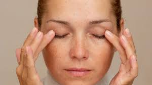 Ozempic is giving people 'temporal hollowing.' Doctors are sounding an alarm.