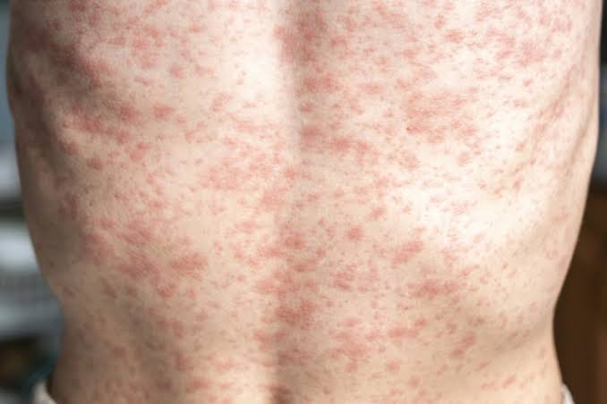 With measles cases on the rise, Oregon health officials urge caution