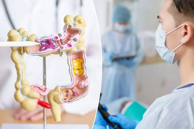 Colon cancer deaths dropped by half for people who did at-home, no-laxative test program