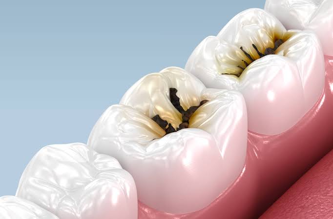 Major U.S. Trial Shows Low-Cost Liquid Can Stop Kids’ Cavities Without Drilling