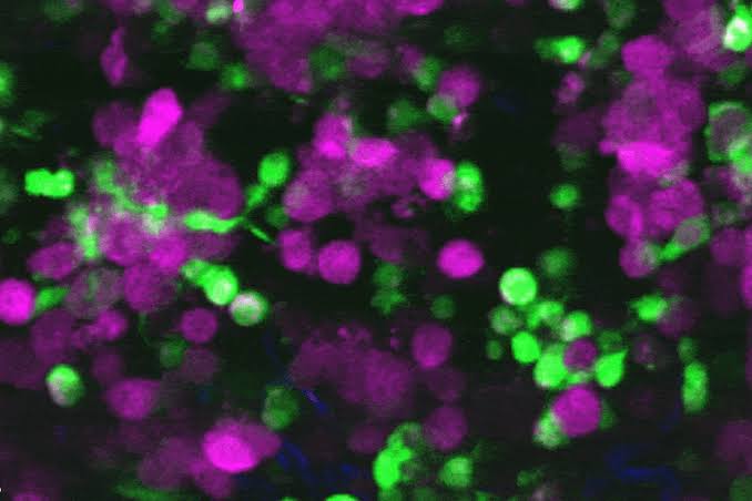 First video of immune cells eating live skin cancer in real time