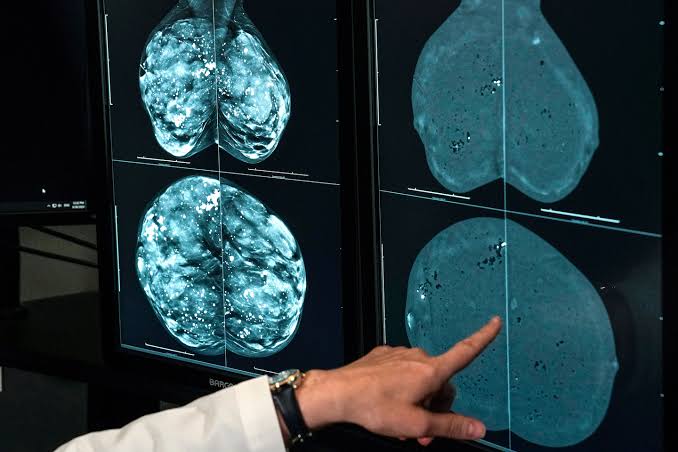 Cancer cases worldwide are expected to soar in the coming decades, a report finds. Here’s why.