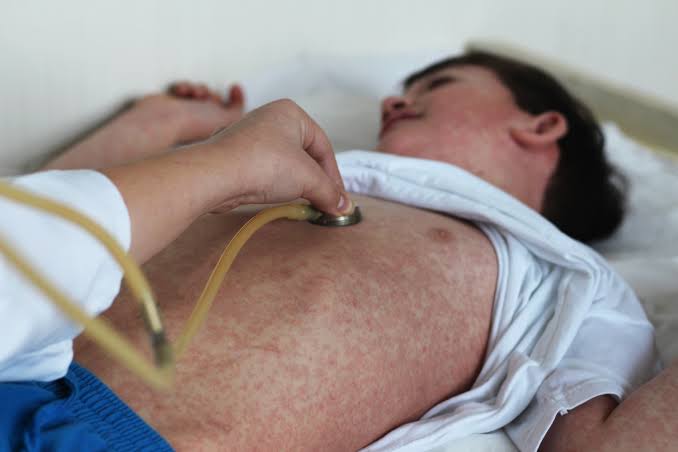 'This might be the point of no return': Experts on the current measles outbreak and where we go from here