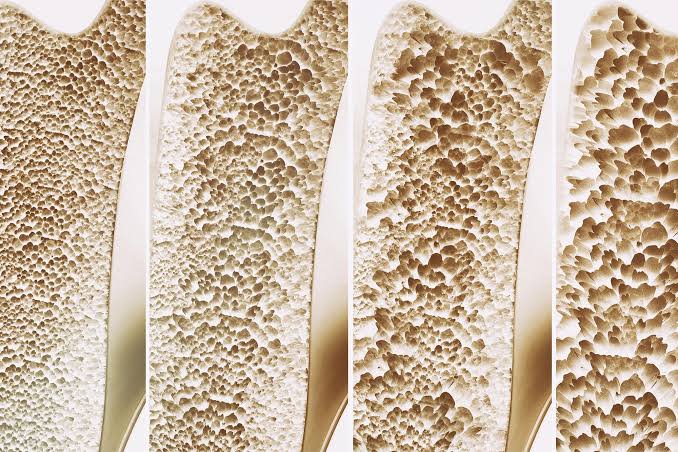 New Discovery Reveals Vitamin K’s Surprising Role in Preventing Bone Loss