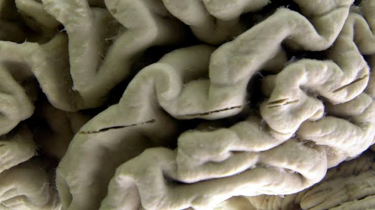 Study shows a blood test can help identify healthy people at high risk for Alzheimer's disease