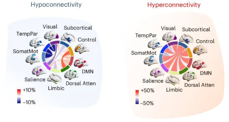 Autism may have two distinct subtypes based on brain connectivity patterns