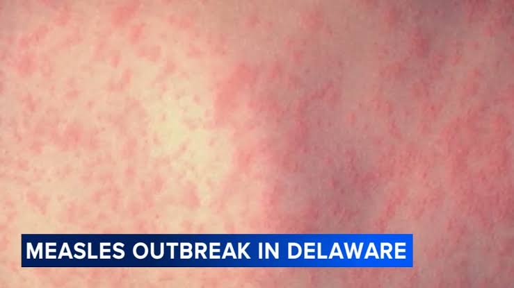 Measles outbreak declared in Delaware; cases also rising in Chester County, Pa.