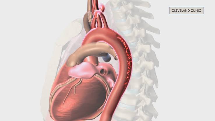 Aortic dissection: Symptoms and who's at risk for this medical emergency