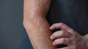 Keratin may act as a 'brake' for skin inflammation, pointing to potential treatments