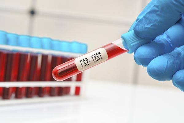 C-reactive protein: Should healthy people be tested for it?
