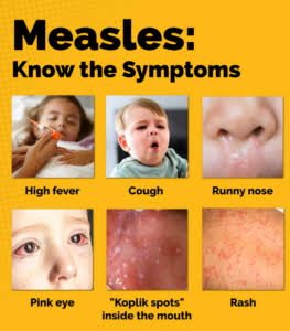 UPDATE: Health Officials Confirm Multiple Measles Cases in St. Mary's County; Possible Exposure at Three Locations Announced