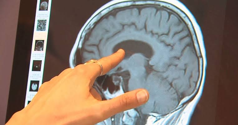 Up to 45% of dementia risk can be prevented, delayed: WHO
