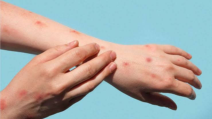 DOH reports mpox found in Oahu water sample