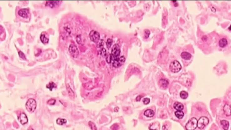 Measles cases break record