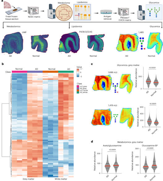 Hyperglycosylation is a metabolic driver of Alzheimer’s disease