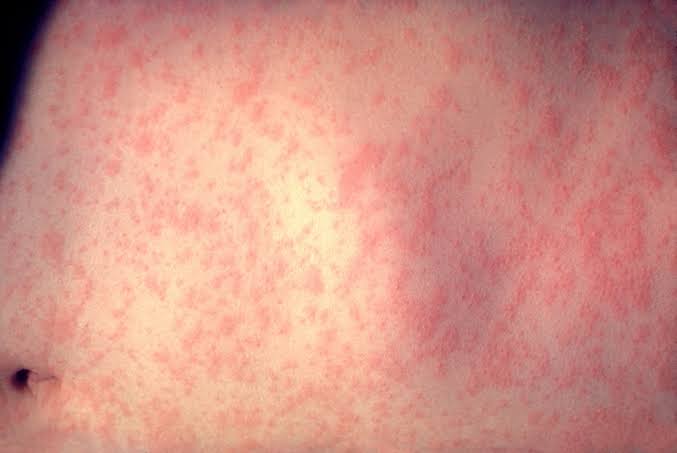 Pa. resident tests positive for measles, might have exposed others at department store