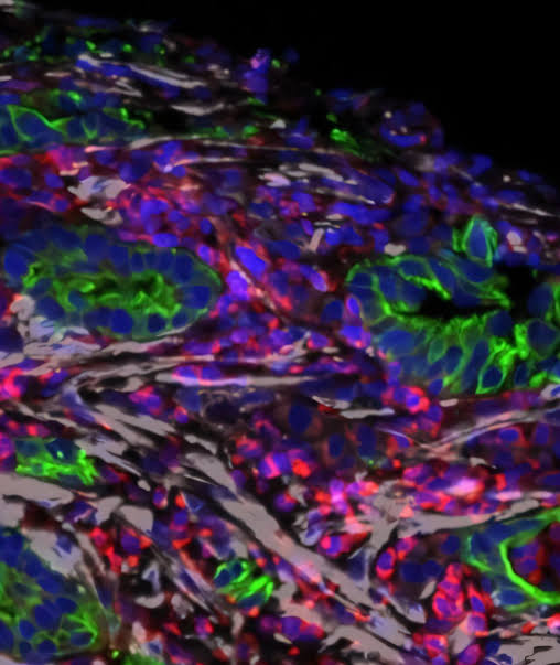 Vitamin D analog shuts down pancreatic cancer's shield in a clinical trial