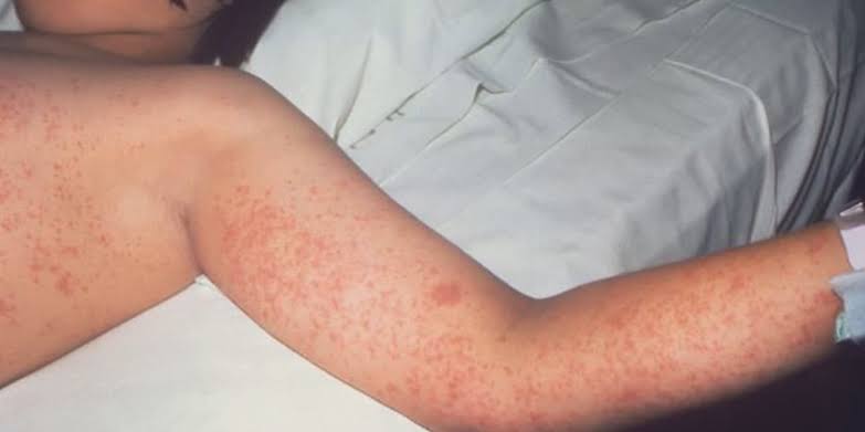 Pima County investigating Measles case