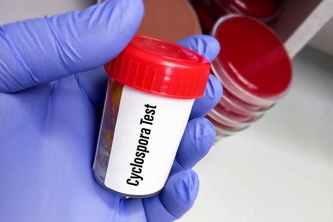Foodborne Parasitic Outbreak That Causes 'Explosive' Diarrhea Has Spread to 17 States